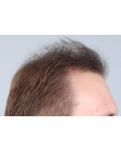 Before Hair Transplant&nbsp;2 Sessions (Areas)
